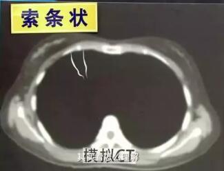 体检后发现“肺部有阴影”一定是得了肺肿瘤?哪些生活习惯(图2)