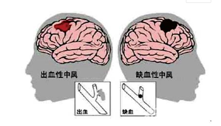 天呀!预防可怕的脑中风，原来这么简单!但还有很多人不知道(图2)
