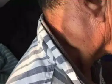 不痛的肿块最可怕!这种小疙瘩可能是癌转移，千万要小心!(图2)