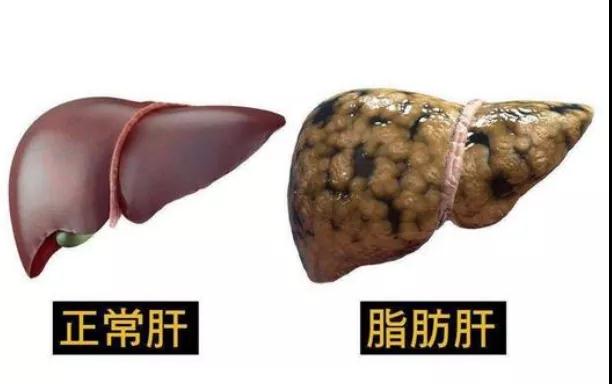 警惕!脂肪肝正在悄悄在癌变(图2)
