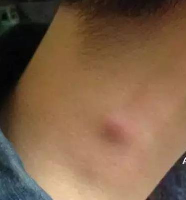 不管男女,脖子上出现这些东西,或许是“癌细胞”在靠近(图4)