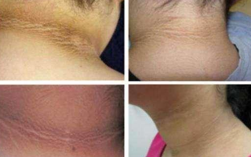 不管男女,脖子上出现这些东西,或许是“癌细胞”在靠近(图2)