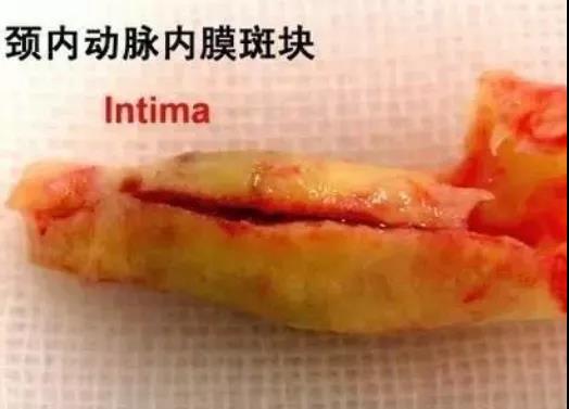血管堵