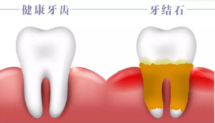 牙结石