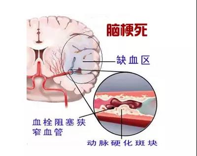 【科普】脑梗:1步自测、3步判断、7步预防(图2)