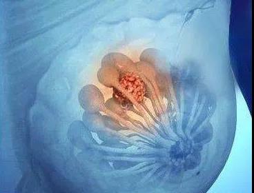 乳腺纤维瘤