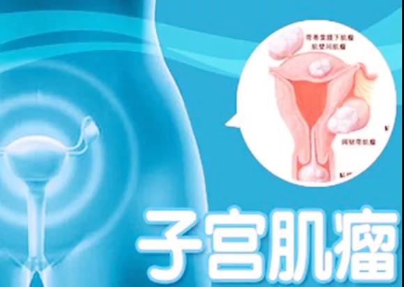 子宫肌瘤