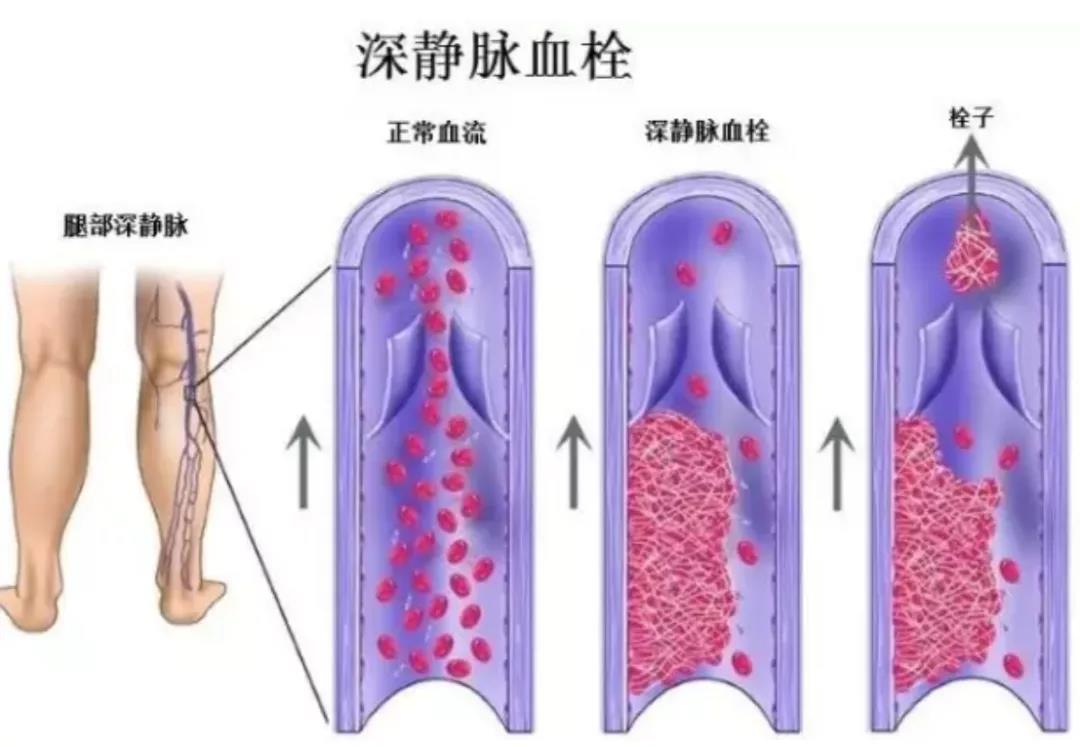 这里的血栓最致命,80%发病前无症状,早预防早远离(图3)