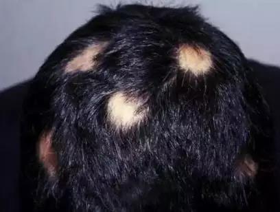 扎心!脱发增加癌症风险?(图3)
