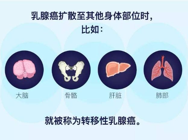 乳腺肿瘤最易出现肺转移,出现这些症状一定要警惕!(图3)