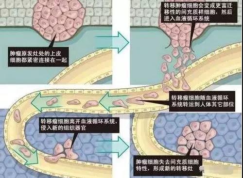 乳腺肿瘤最易出现肺转移,出现这些症状一定要警惕!(图2)
