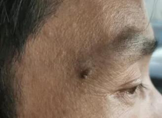 医生看了一眼这个“痣”，就说是肝癌信号?这25种痣也是...(图19)