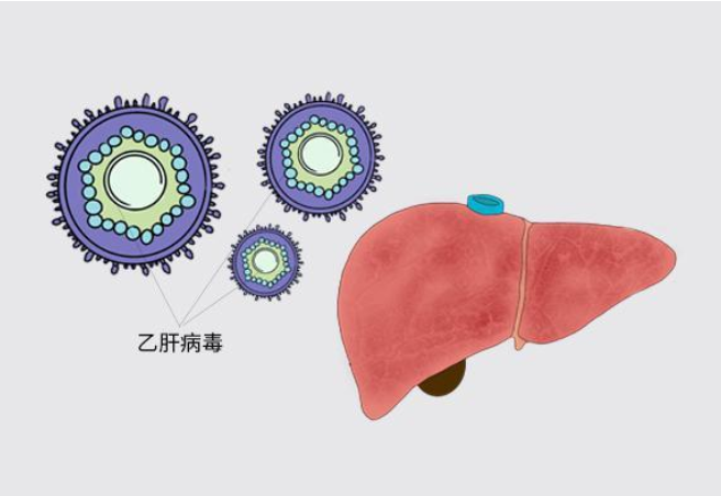得了乙肝，有多大概率会恶化成肝癌？(图3)
