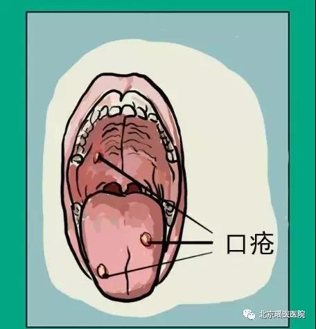 【专家提醒】反复口腔溃疡别大意，当心淋巴瘤(图3)