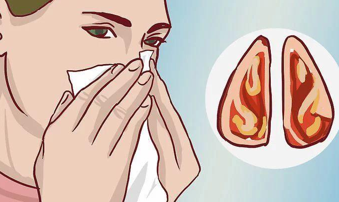 鼻塞、鼻出血…以为是鼻炎，其实可能是癌症来袭！(图3)