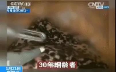 他抽烟30年，肺的照片刷爆朋友圈,看完你还抽烟吗?(图5)