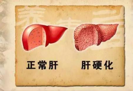 肝硬化,会发出“1痒、2黄、3舌”的求救信号,占一个...(图2)