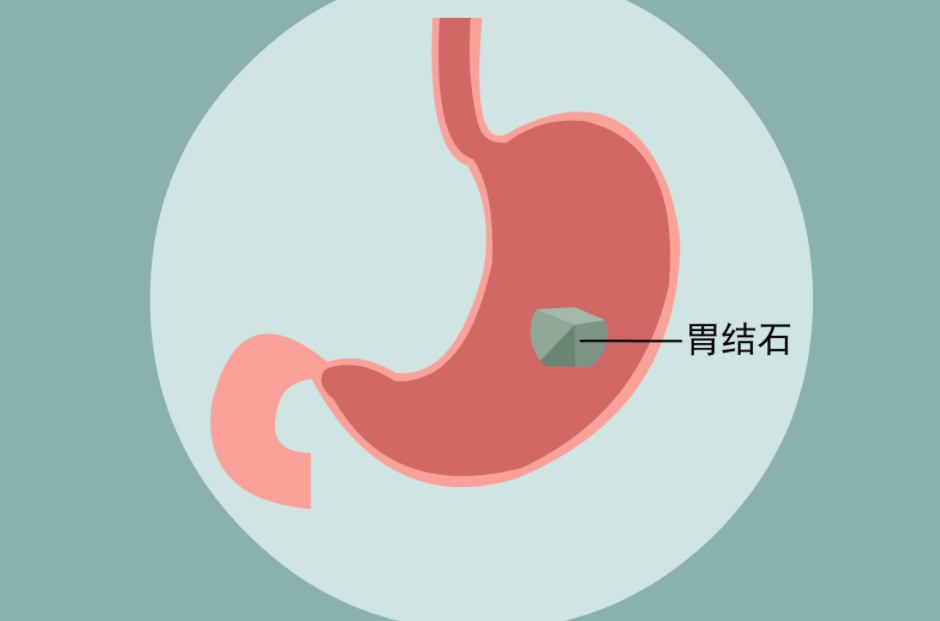 结石很常见,却增加13倍肿瘤发病率!(图2)