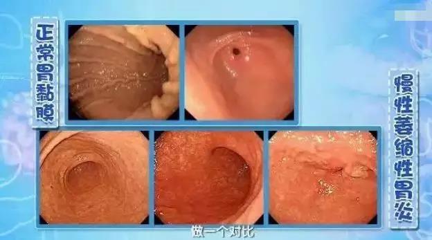 【荐读】肿瘤来之前,都会有“瘤前病变”!很多人没重视(图2)