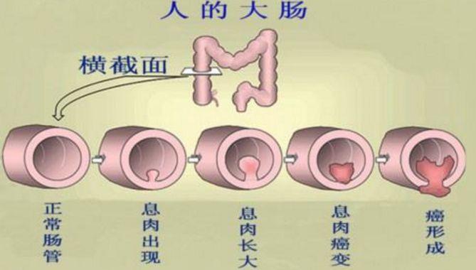 吓人!14个肠镜中13个有癌前病变，1个确诊肠癌!(图3)