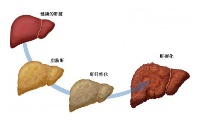 超40%成年人被脂肪肝“绑架”！颈围超过这个数要当心(图2)