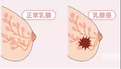 乳腺增生、结节、癌,摸起来是啥感觉?医生教你分辨(图2)