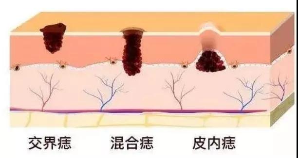 癌症真相：癌前病变距离癌症有多远?这7种病症要抓紧治疗(图5)